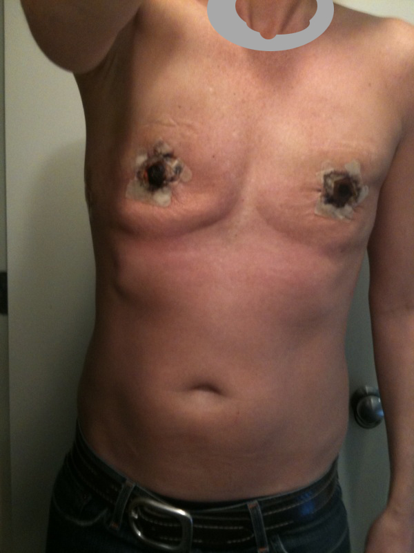 What causes a seroma after back surgery?